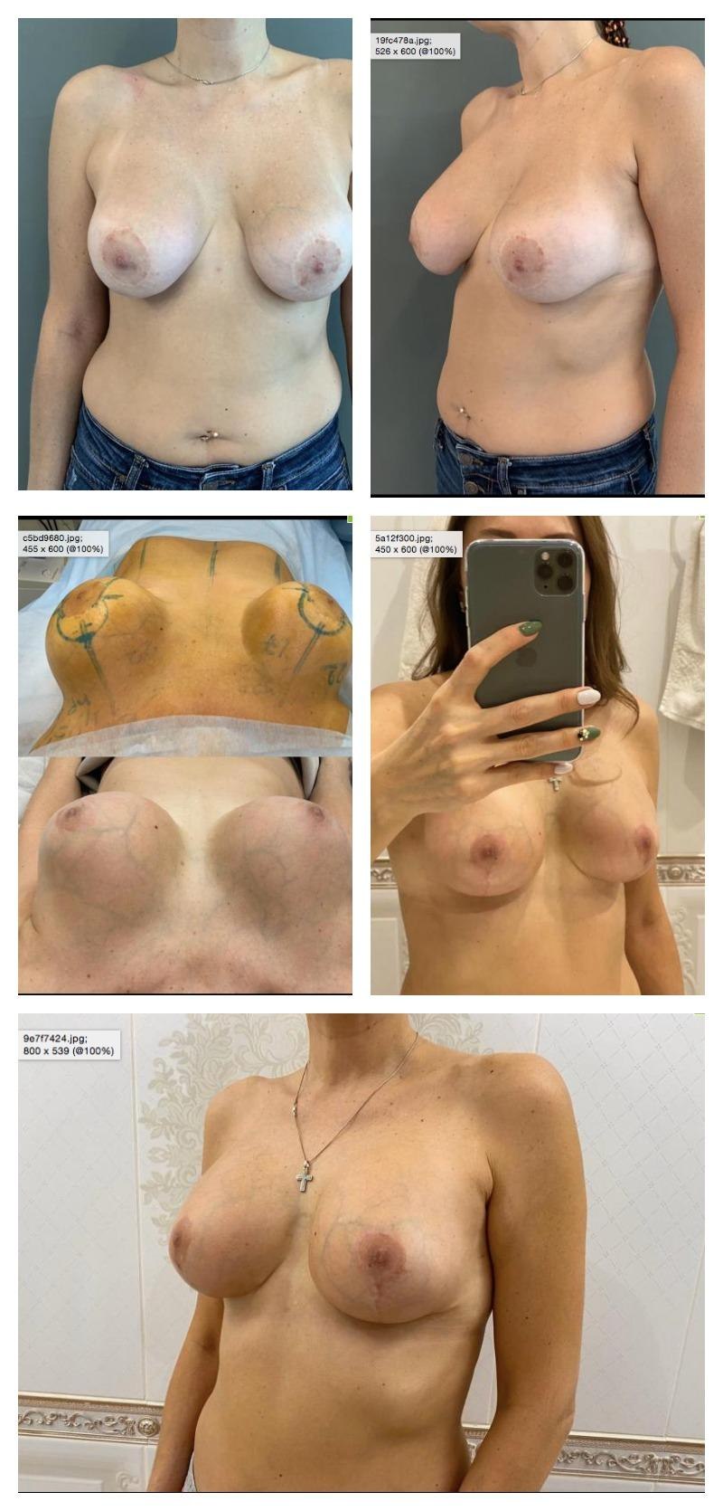 Aletta Ocean Boobs avant après