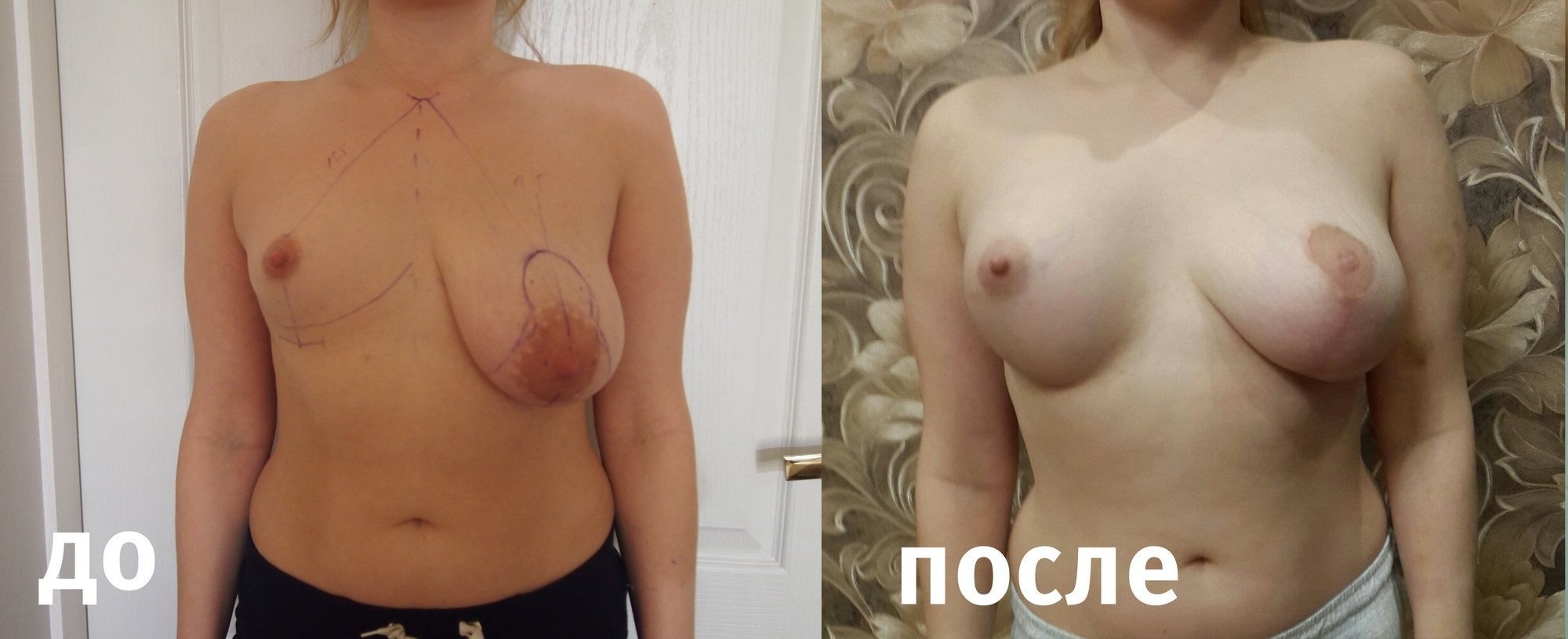 увеличилась грудь у женщин фото 33