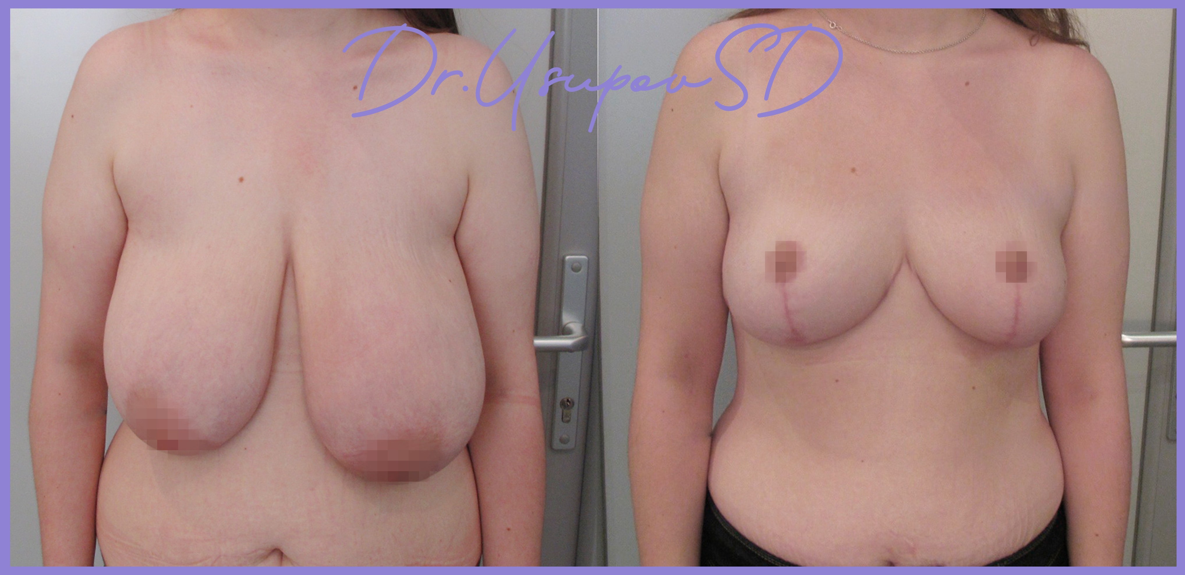 как проходит операция по уменьшению груди у женщин фото 95