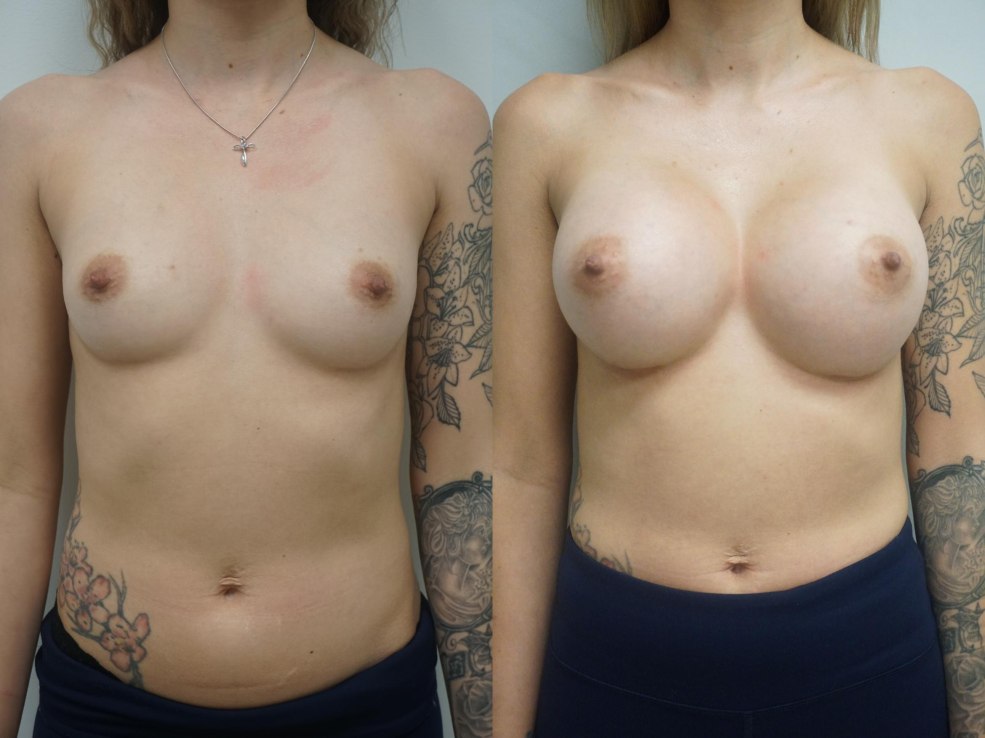 Mestes féminines avec des implants nus