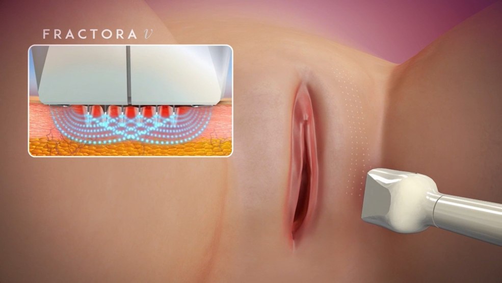 Rajeunissement vaginal