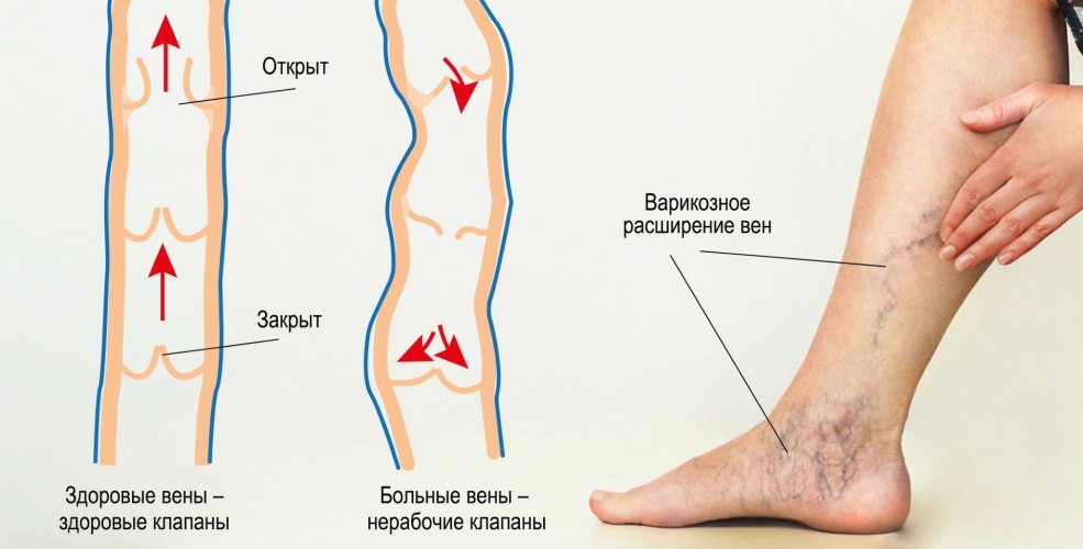 Varices de la classification des membres inférieurs