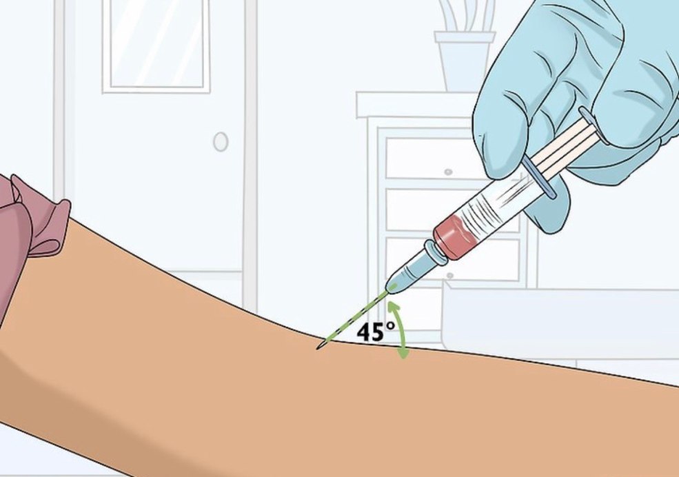 Angle d'injection intraveineuse d'introduction de l'aiguille