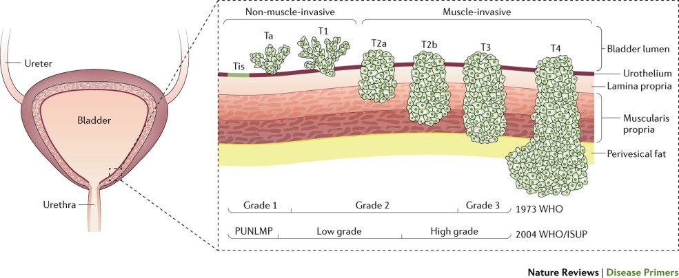 Adénocarcinome de la pathogenèse de l'estomac