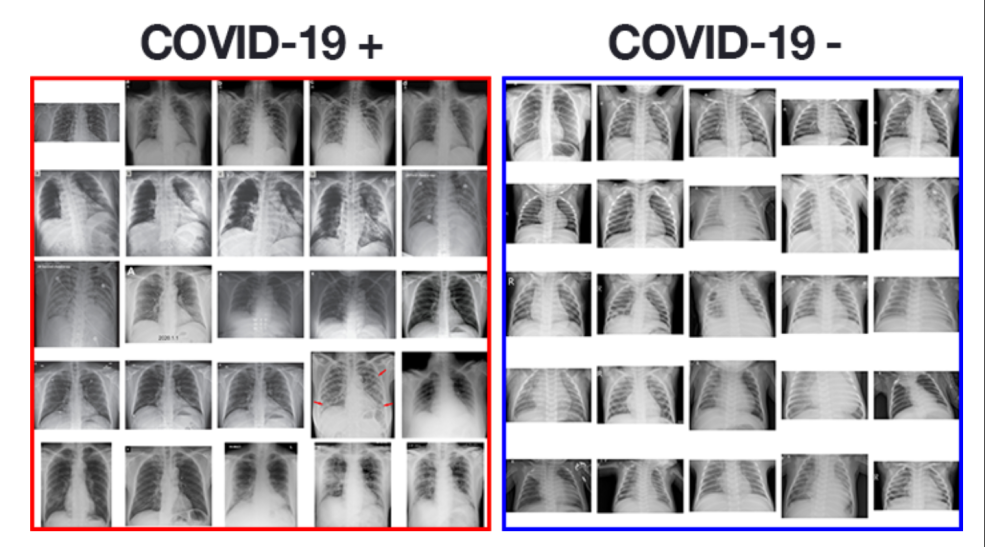 Image covide 19 X -RAY
