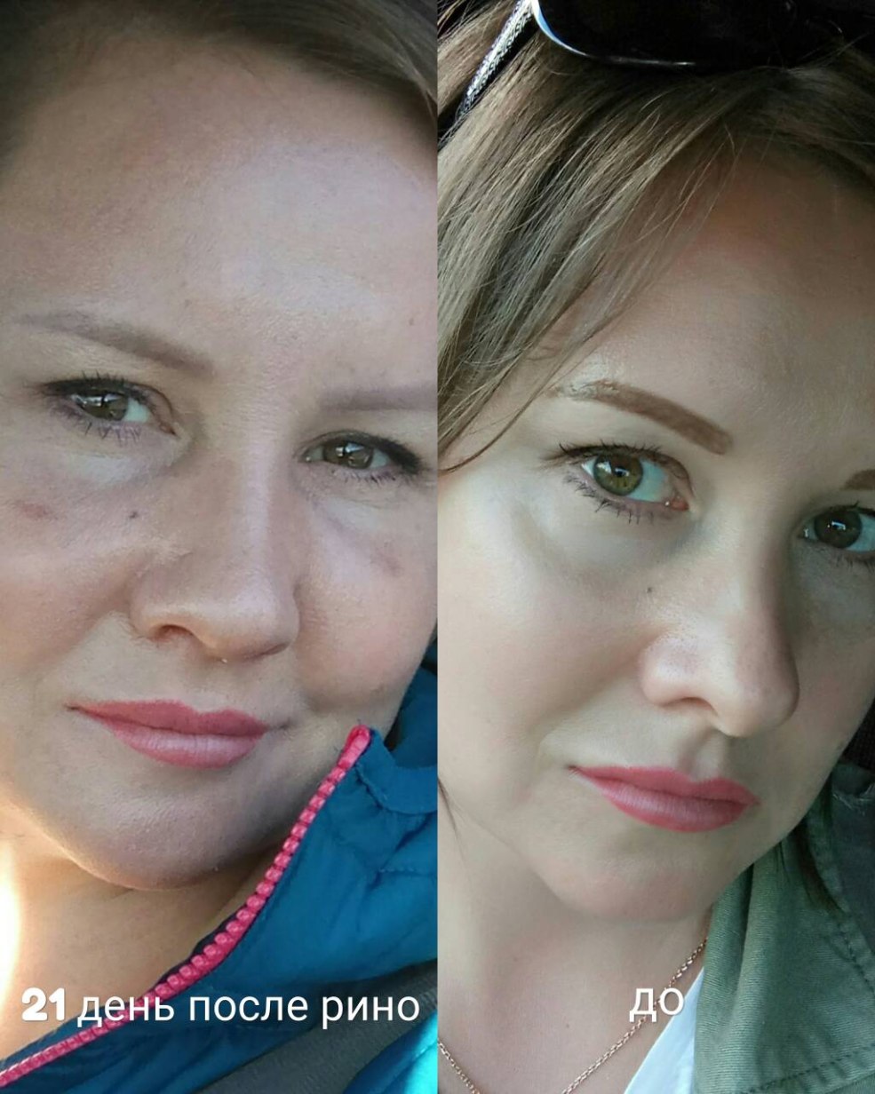 Ecchymoses sous les yeux après Rino