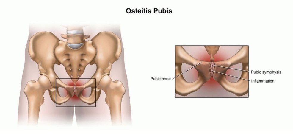 Tableau de comparaison avant et après avoir porté Faja Colombianas