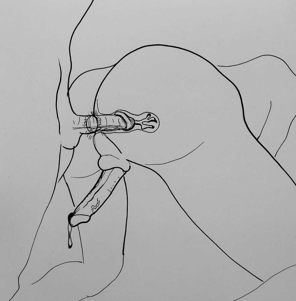 Expanseur vaginal à l'intérieur