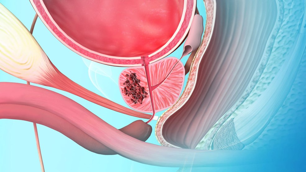 Liquide de la prostate à quoi ressemble une photo